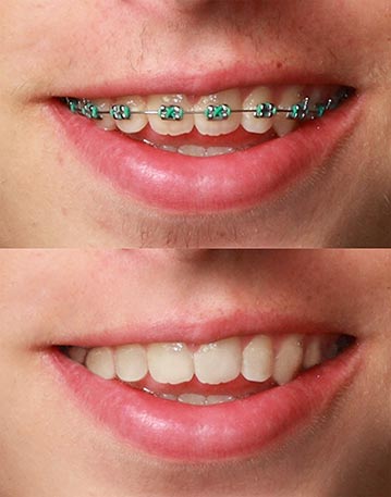 Braces removal